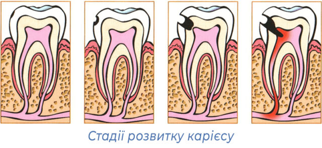 Стадії розвитку карієсу