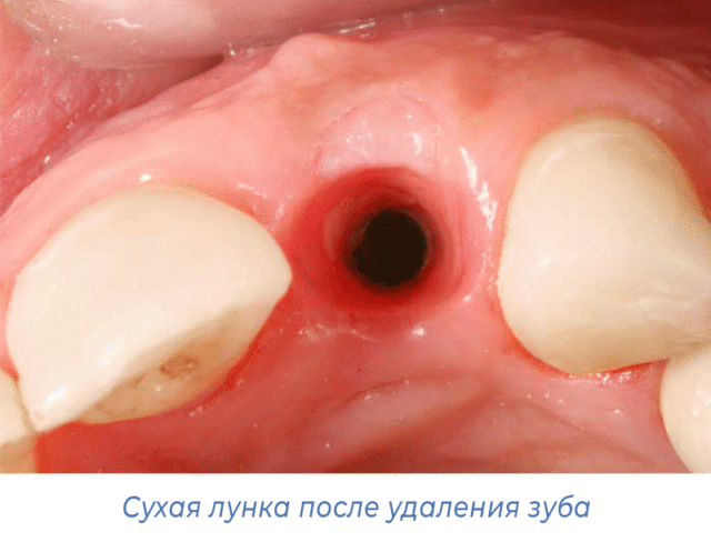 Сухая лунка после удаления зуба