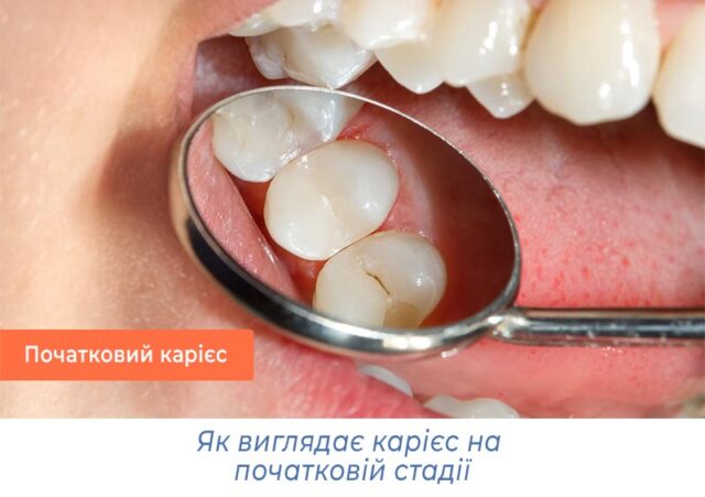Як виглядає карієс на початковій стадії