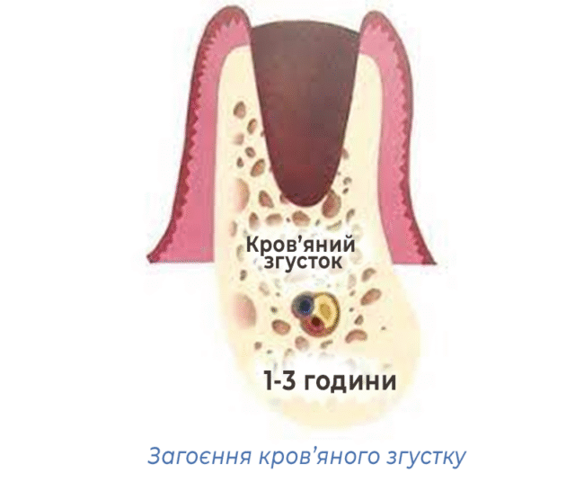 Загоєння кров’яного згустку
