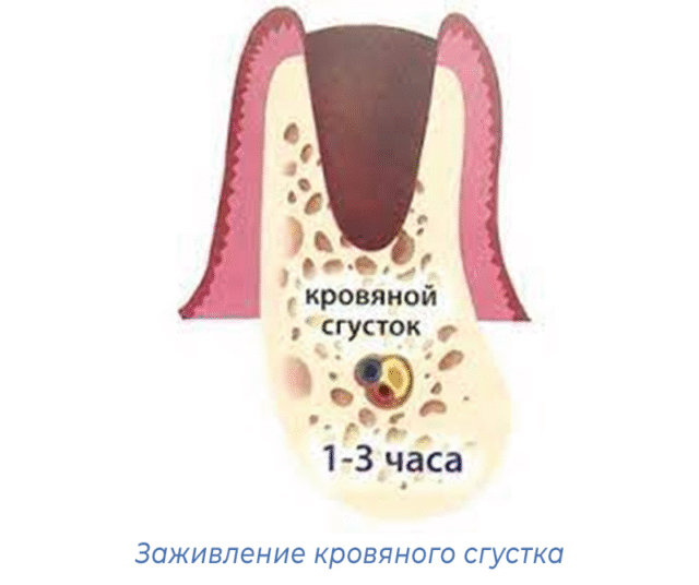 Заживление кровяного сгустка