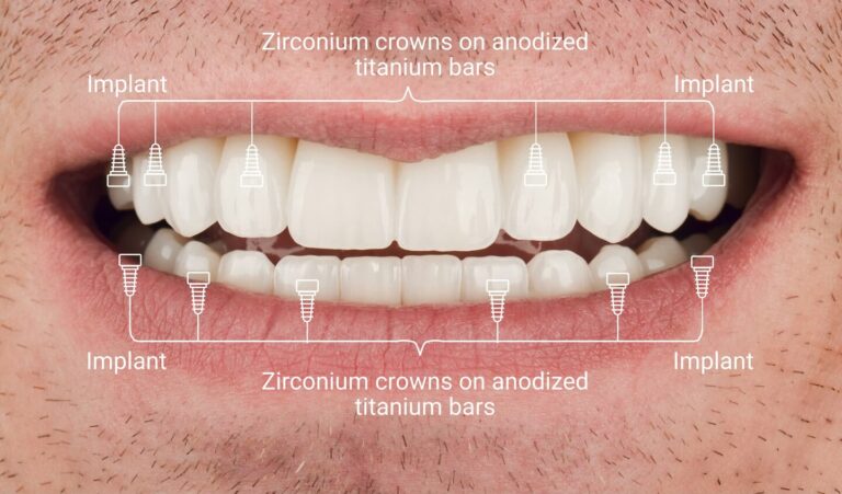 Complete smile restoration: a combination of two types of implant-supported dentures restored aesthetics and full chewing function