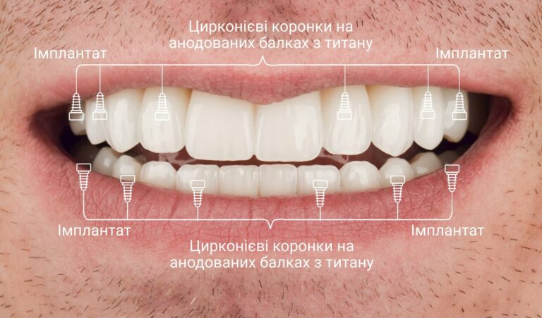 Повне відновлення усмішки: поєднання двох типів протезів на імплантатах дозволило повернути естетику та повноцінне жування