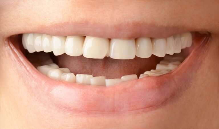 Aesthetic rehabilitation of failed metal-ceramic crowns after 12 years of use