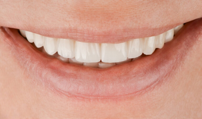 Aesthetic rehabilitation of failed metal-ceramic crowns after 12 years of use