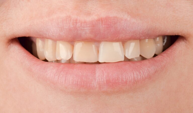 Inlays. Photo before