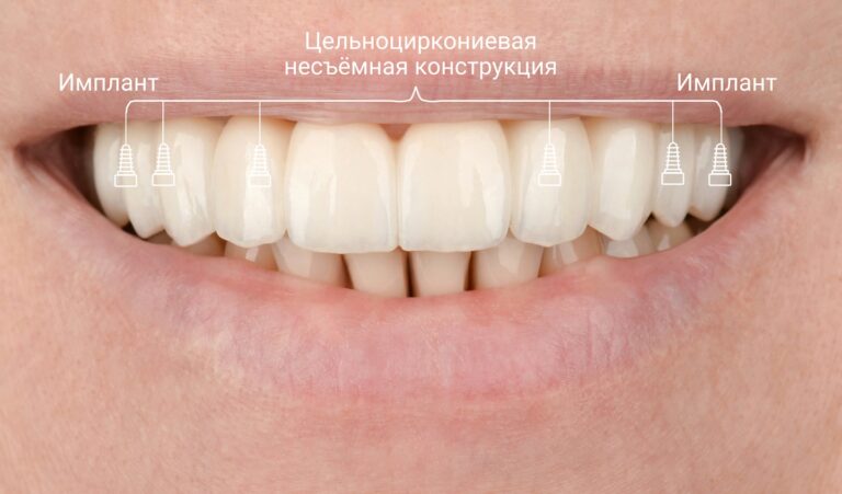 К общепринятым абсолютным противопоказаниям для.... Фото после