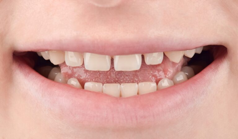 Aesthetic smile rehabilitation using ceramic veneers