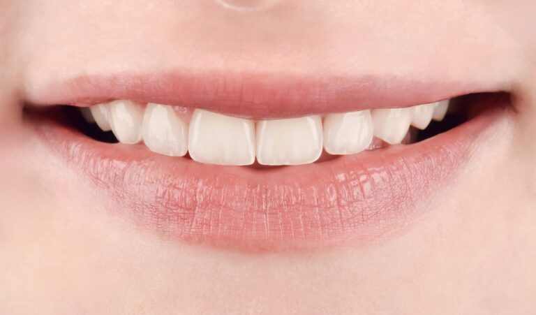 Aesthetic smile rehabilitation using ceramic veneers