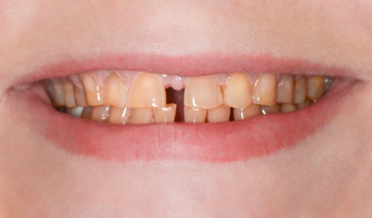 Diastema Closure and Smile Restoration — Comprehensive Treatment