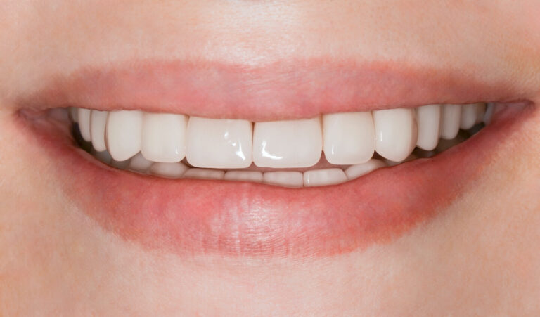 Diastema Closure and Smile Restoration — Comprehensive Treatment
