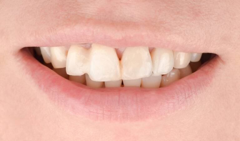 Restoration of a maxillary central incisor using simultaneous implantation and soft tissue grafting