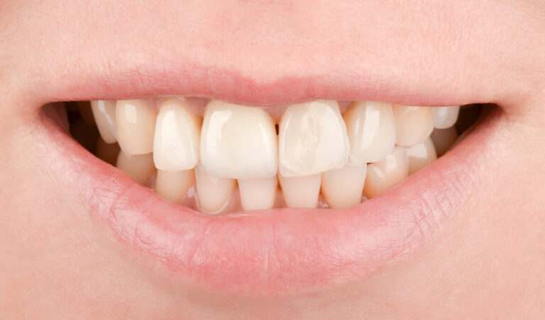 Restoration of a maxillary central incisor using simultaneous implantation and soft tissue grafting