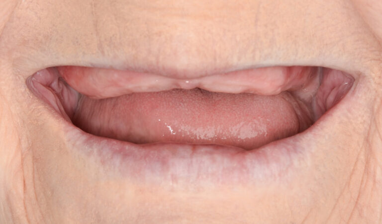 A new smile for the one day: All-on-4 implantation