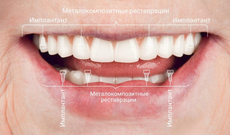 Новая улыбка за один день: имплантация All-on-4