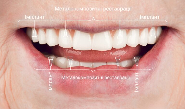 Нова усмішка за один день: імплантація All-on-4