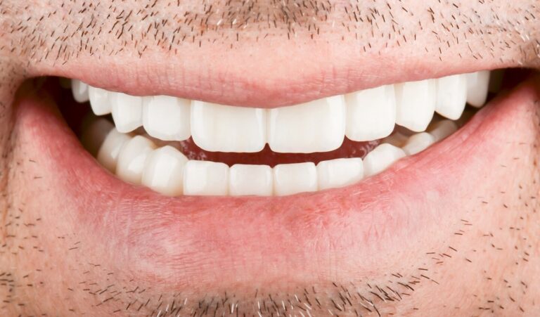 Advantages over bone grafting. Photo after