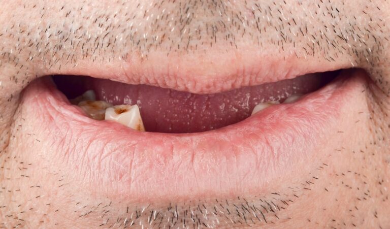 Advantages over bone grafting. Photo before