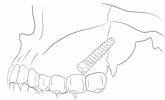Who does this method work for? Illustration