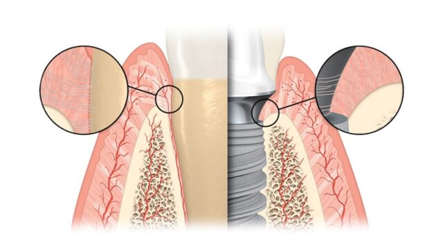 Dental implants for periodontitis