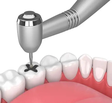 Tooth surface filling