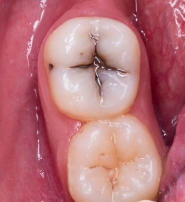 Darkening of fillings