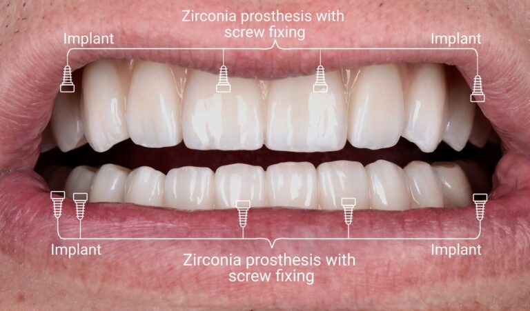 Restorations for a patient with severe periodontitis using All-On-4 treatment concept by Nobel Biocare
