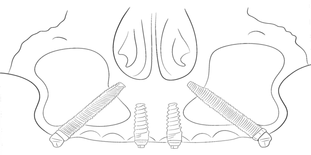Maxilla-For-All Tooth Restoration Illustration