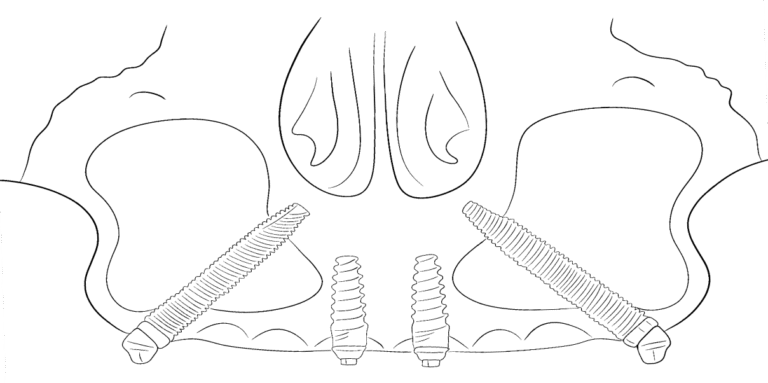 tooth-crown+inlay-01487
