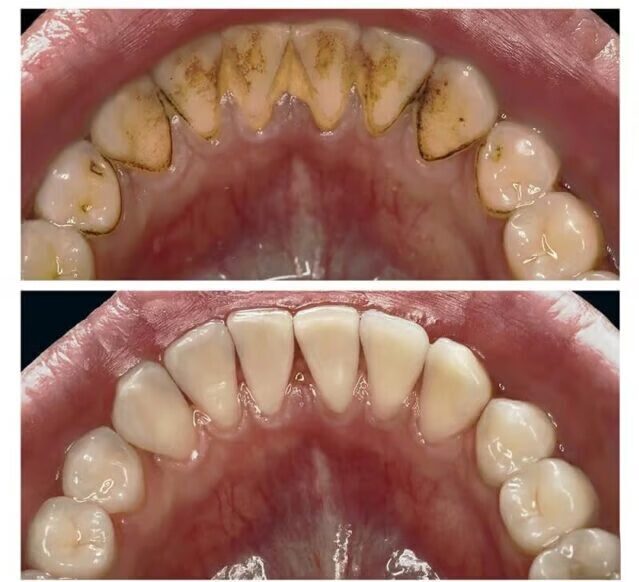 Ультразвукова чистка