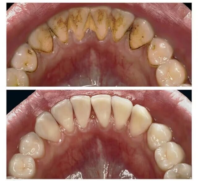 Ультразвуковая чистка