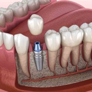 Implant placement in periodontitis