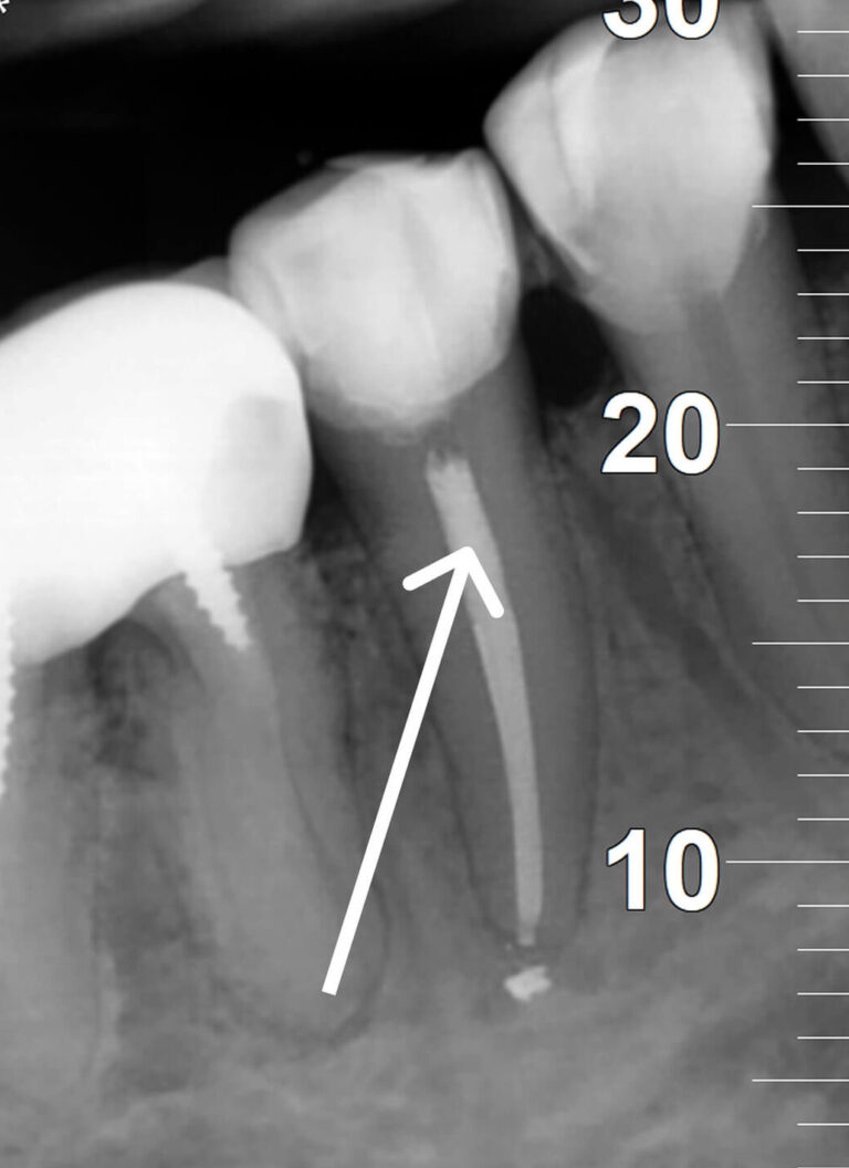 Root Canal Treatment Through the Crown: Saving the Permanent Restoration
