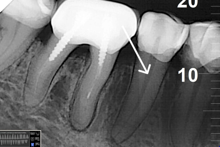 Root Canal Treatment Through the Crown: Saving the Permanent Restoration