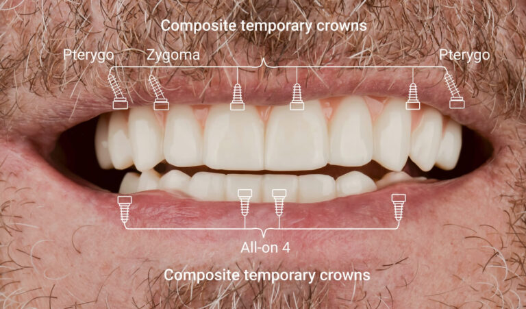 Complete rehabilitation for edentulism without bone grafting: a solution for a 70-year-old patient