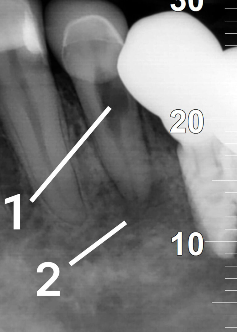 Successful Treatment of Internal Root Resorption and Asymptomatic Apical Periodontiti