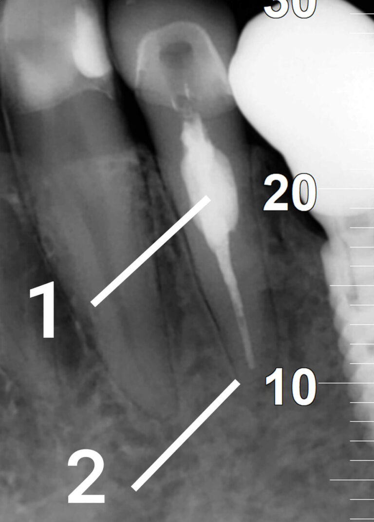 Successful Treatment of Internal Root Resorption and Asymptomatic Apical Periodontiti