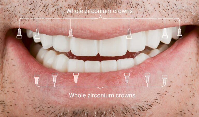 Full mouth implant rehabilitation using the “All-on-6” protocol with pterygoid support