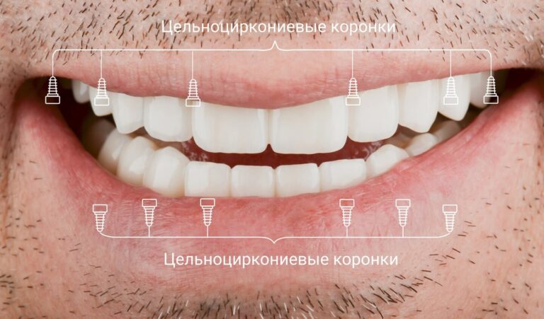 Клинический случай: All-on-6 с птеригоидной опорой и цельноциркониевыми коронками