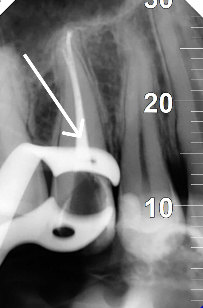Irreversible Pulpitis Treatment in Tooth 15 in One Visit: Case Study