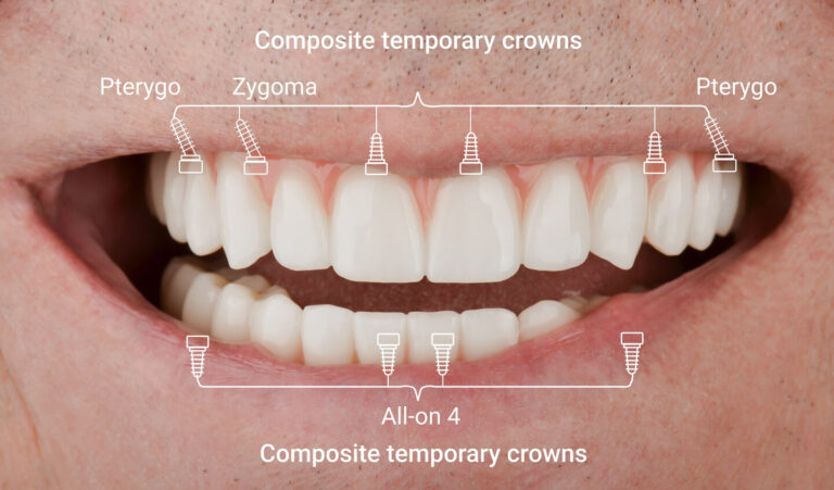 Complete rehabilitation for edentulism without bone grafting: a solution for a 70-year-old patient
