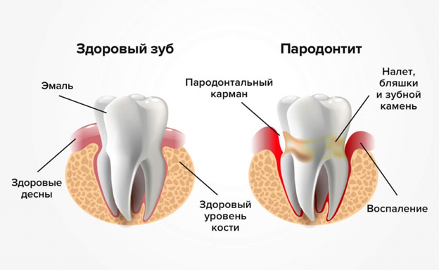 Метилурацил Мазь При Пародонтозе